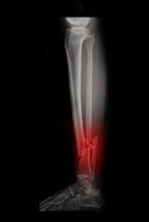 bone fractures