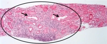 Acute Interstitial Nephritis AIN