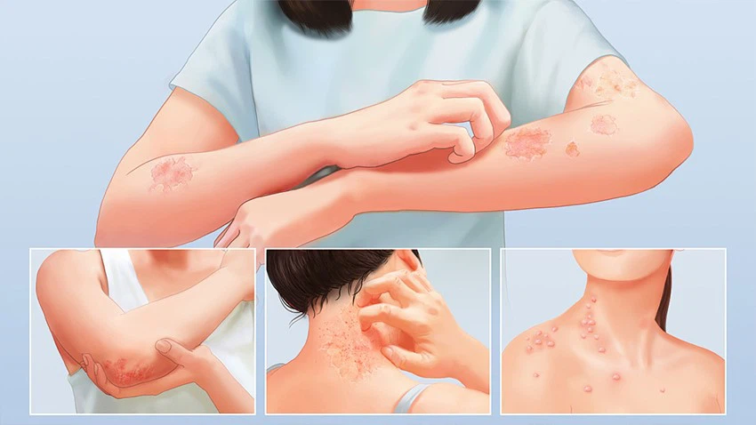 Tapinarof powder Tapinarof powder