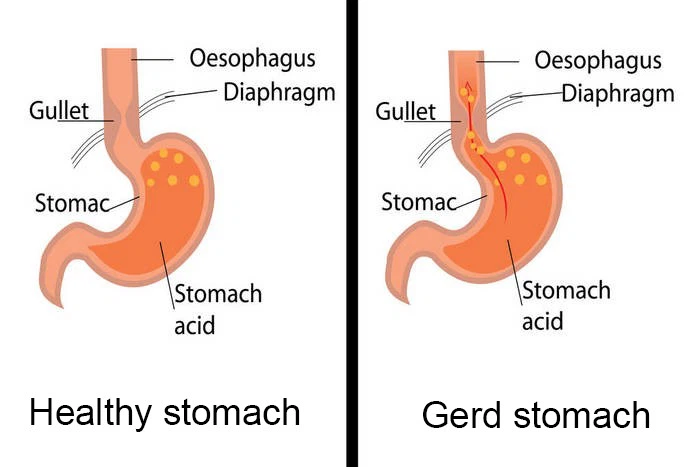 Gastroesophageal Reflux Disease (GERD) Gastroesophageal Reflux Disease (GERD)