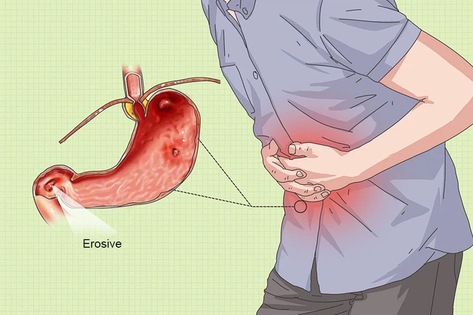 Erosive Esophagitis Erosive Esophagitis
